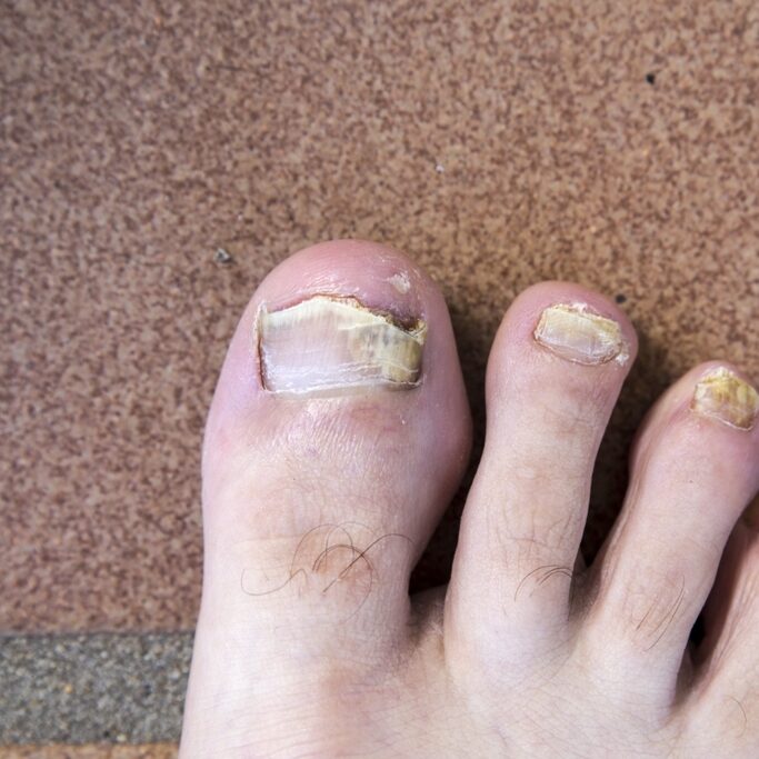 Toes with fungal nails