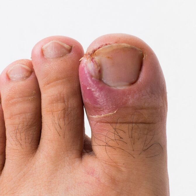 An ingrown toenail