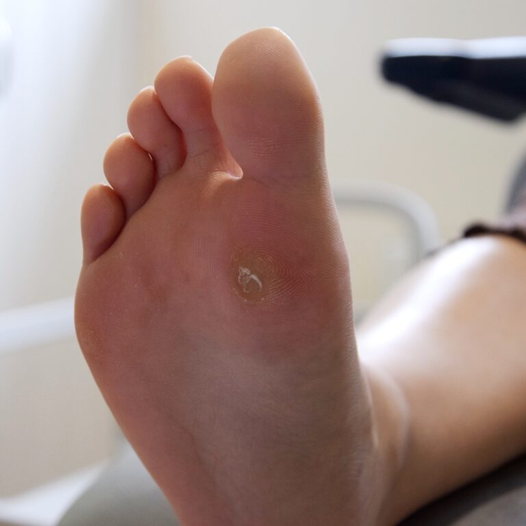 A verruca on the sole of a foot